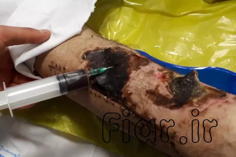 پرستاردرمانگر زخمهای بستر،پای دیابتی،زخمهای عفونی و…._