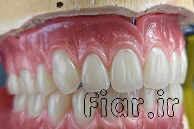 ساخت انواع دندان مصنوعی،ساخت پلاک کروم کبالت براساس فک،ساخت پروتز فلکسی و…