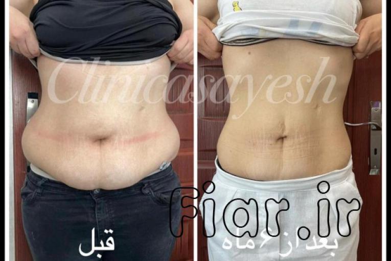 لاغری بدون جراحی با کرایولیپولیز